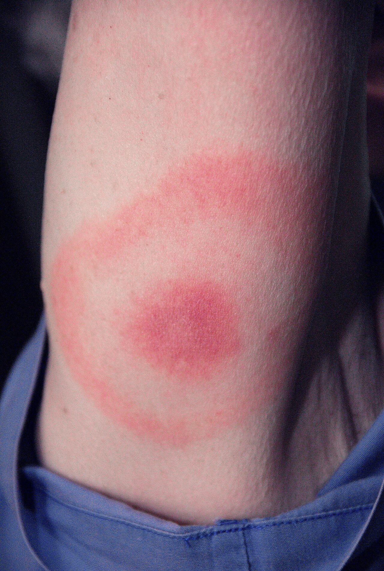 Borrelioosin rengasmainen ihottuma